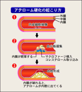 アテローム性動脈硬化